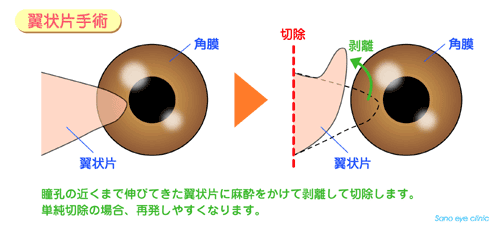 翼状 片