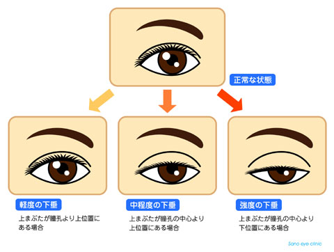 保険 適用 下垂 眼瞼