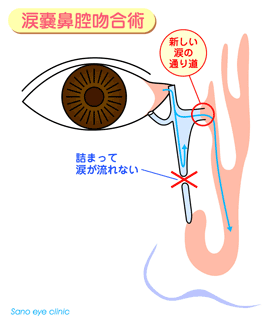 涙嚢鼻腔吻合術