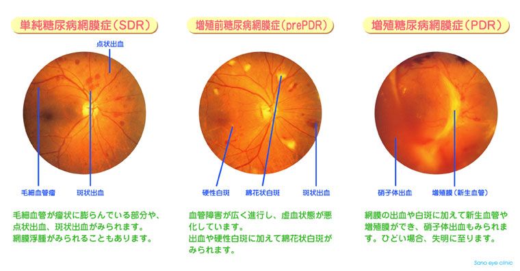 網膜 症 糖尿病