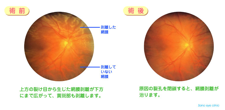 剥離 原因 網膜 網膜剥離の原因・メカニズム [目の病気]