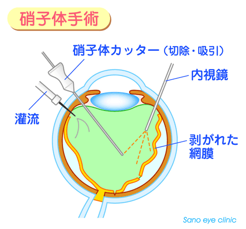 硝子体手術